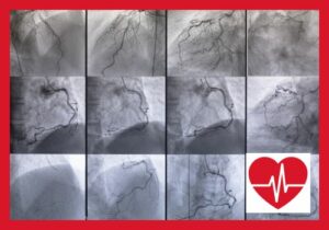 Herzkatheter und Koronarangiographie: Schlüsselverfahren der Kardiologie