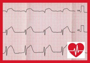 Myokardszintigraphie: Innovative Diagnostik der Herzdurchblutung