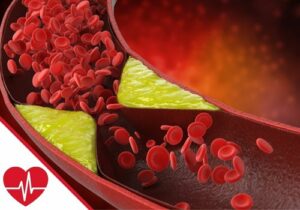 Arteriosklerose: Was ist Artierienverkalkung?